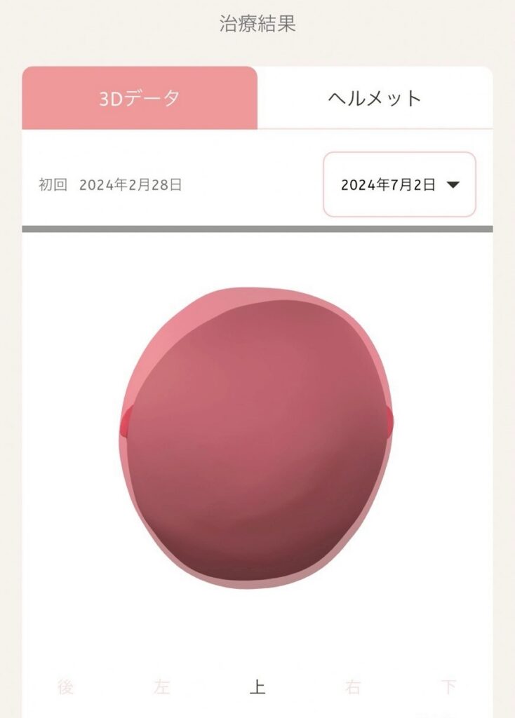 治療後の3Dデータ(上)